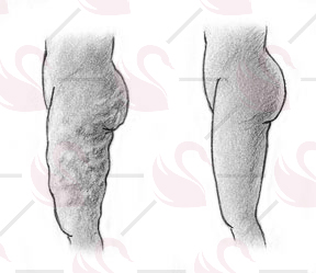 Oberschenkel vor und nach der Lipödem-OP (Liposuktion) in einer Schwarz-Weiß-Zeichnung dargestellt.